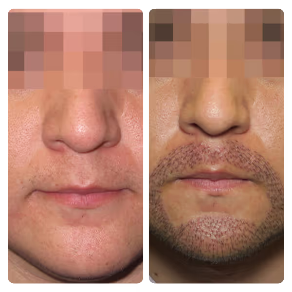 Moustache Transplant in Turkey